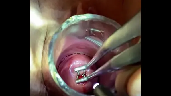 XXX Bakes dilator enters through endocervical speculum ภาพยนตร์ขนาดใหญ่